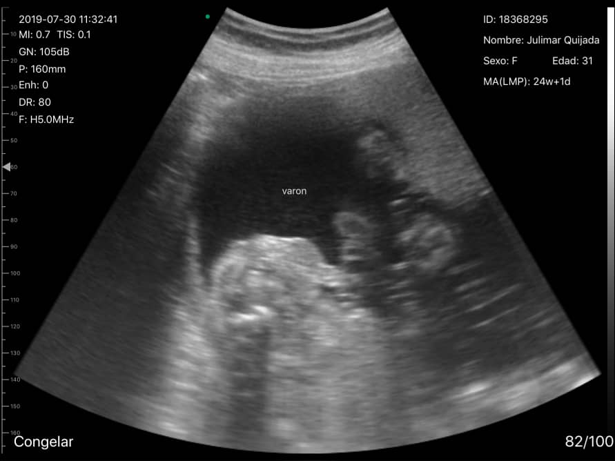 胎儿图像（UProbe-5C）