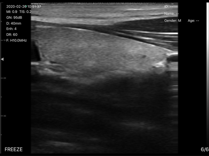 颈动脉与甲状腺图像（UProbe-5L线阵无线探头式B超）